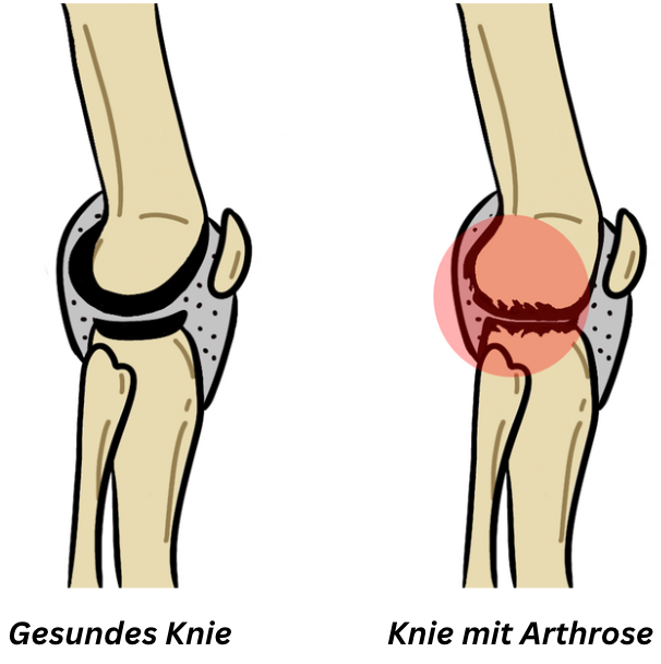 Medizinische Illustration eines gesunden Knies im Vergleich zu einem Knie mit Arthrose, bei dem der Knorpel abgebaut ist und Schmerzen entstehen